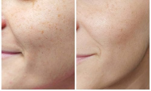 microneedling örebro dermapen ansikte före efter