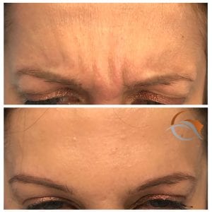 Botox argrynka glabella före och efter örebro