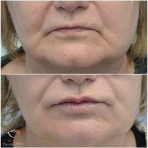 Filler läppar föryngring sura mungipor behandling örebro