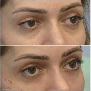 Fillers Tear trough örebro ta bort mörka ringar under ögonen