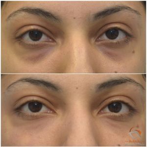 Filler ögon Örebro