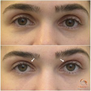 Fillers övre ögonlock före och efter behandla hålögdhet insjukna ögon