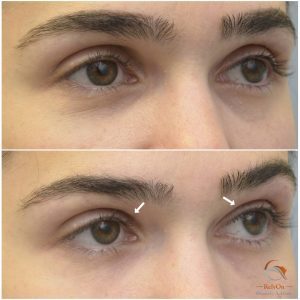 Fillers övre ögonlock före och efter behandling av hålögdhet insjukna ögon