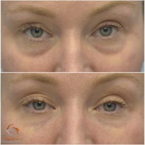 Fillers under ögonen före efter