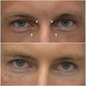 Fillers övre ögonlock merry eyes hålögdhet