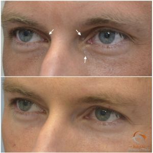 Ögonlocksplastik utan kirurgi med fillers